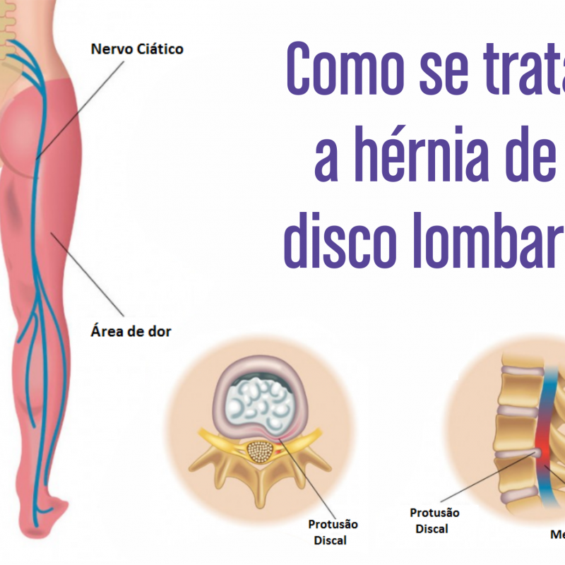 Sintomas De Hernia De Disco Na Lombar